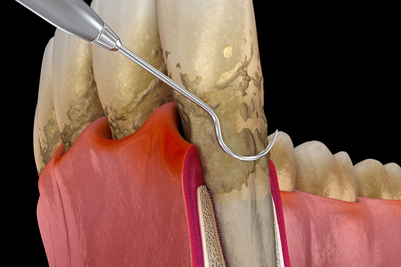 Periodontal Treatment in Montville