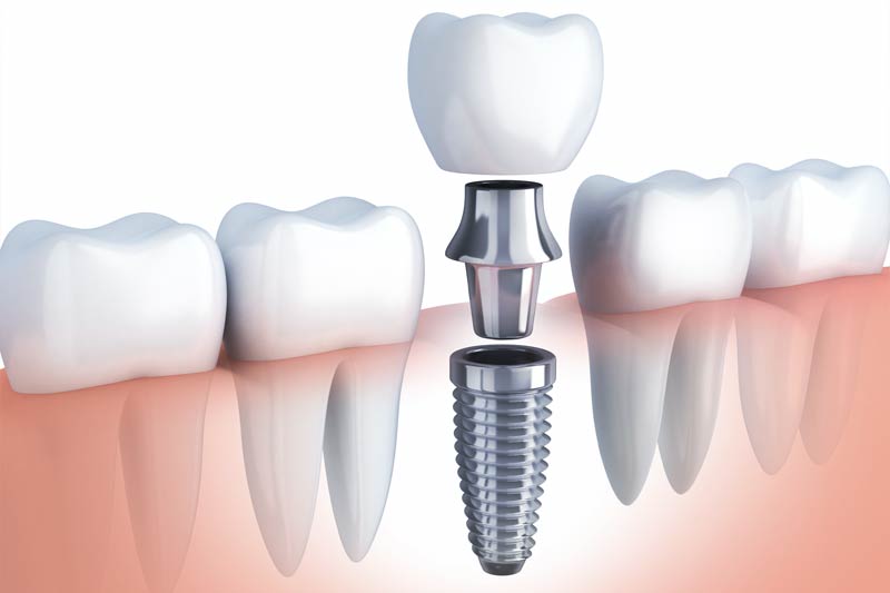 Implants Dentist in Montville