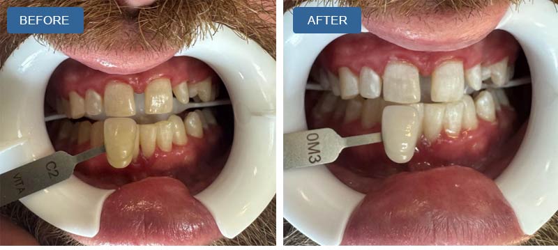 Teeth Whitening in Montville