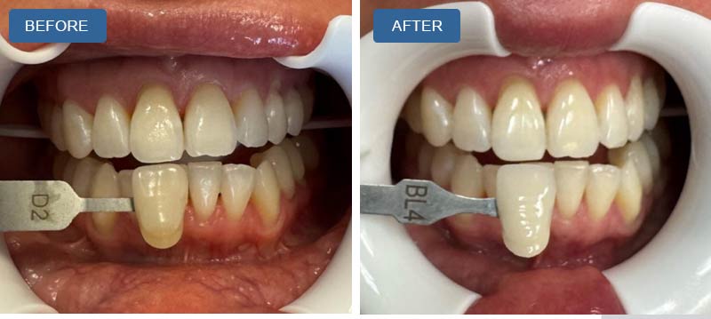 Teeth Whitening in Montville