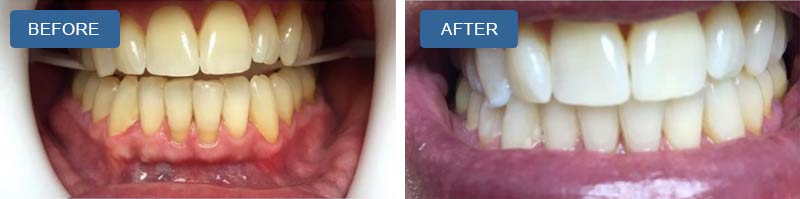 Teeth Whitening in Montville